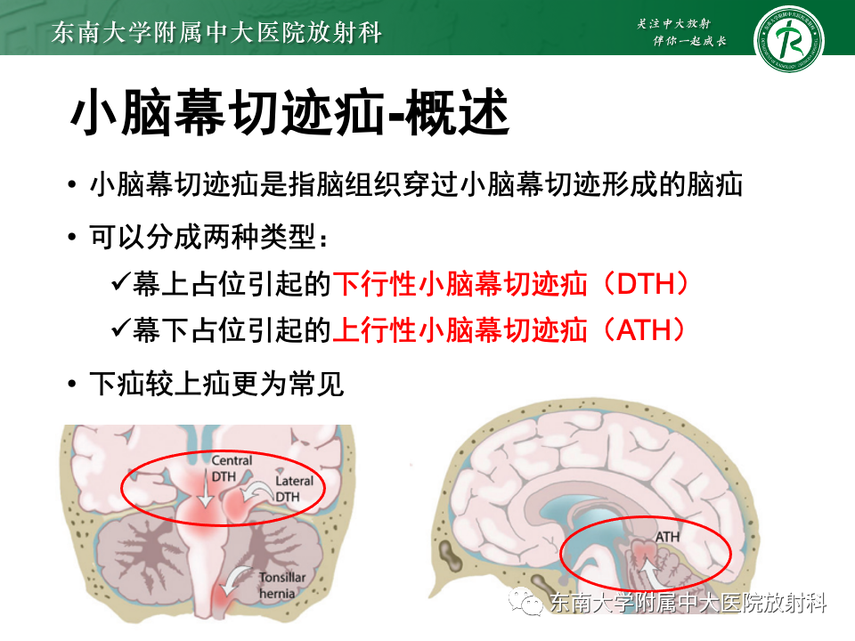 影像PPT - 【PPT】颅内疝-13
