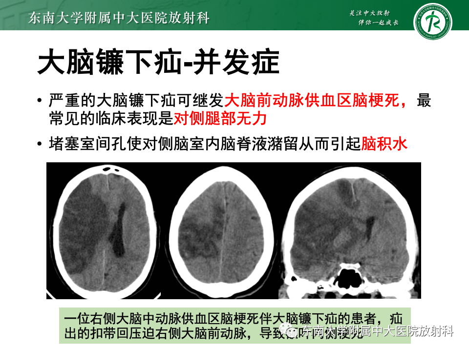 影像PPT - 【PPT】颅内疝-12