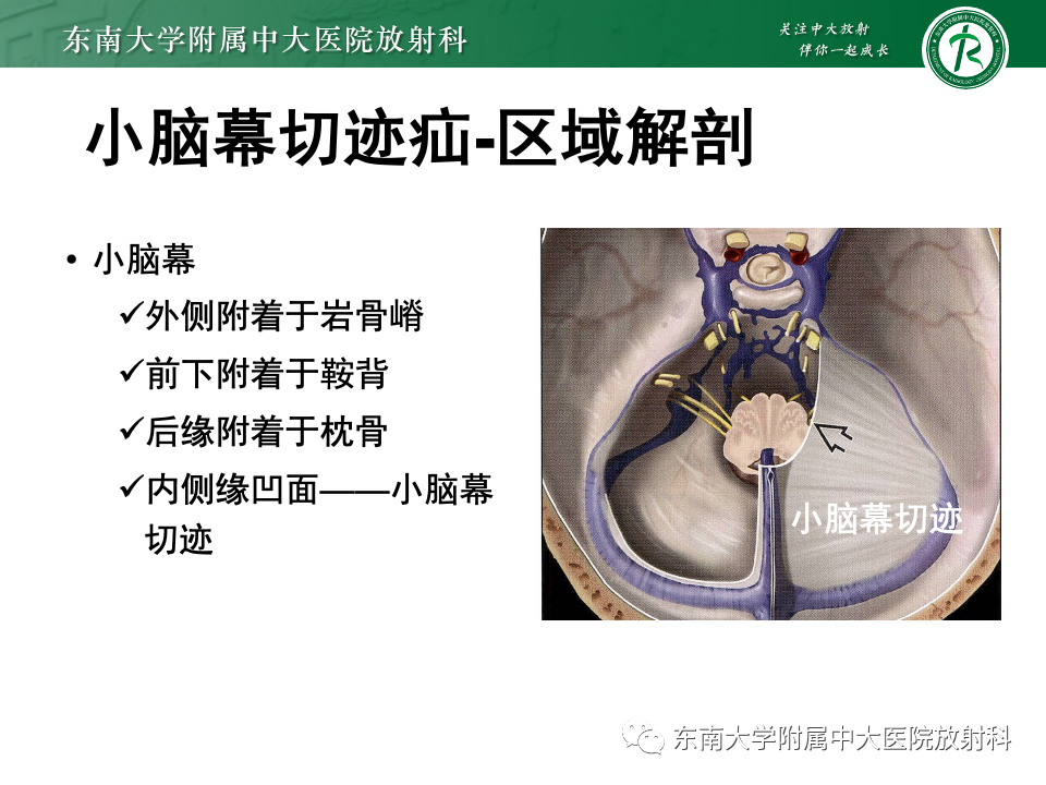 影像PPT - 【PPT】颅内疝-14