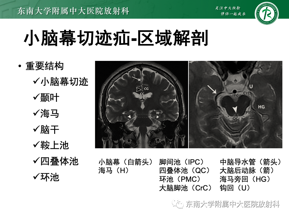 影像PPT - 【PPT】颅内疝-15