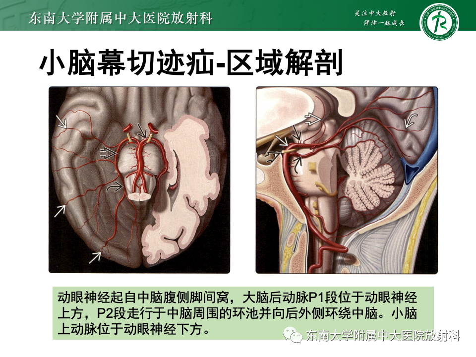 影像PPT - 【PPT】颅内疝-16