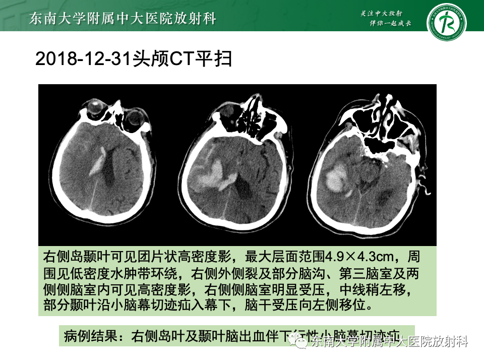 影像PPT - 【PPT】颅内疝-18