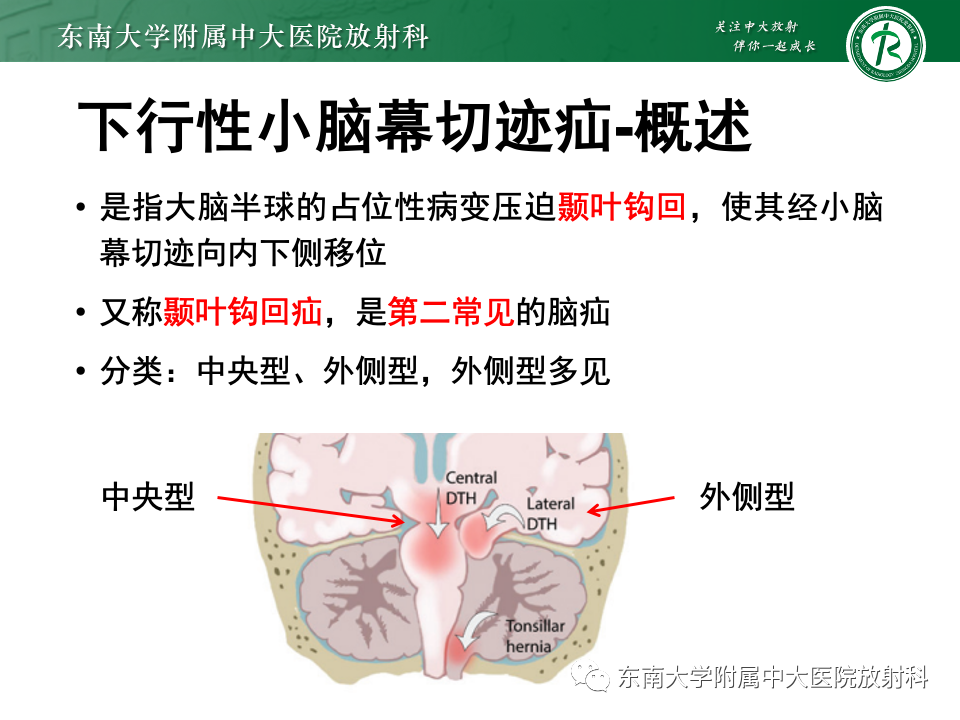 影像PPT - 【PPT】颅内疝-19