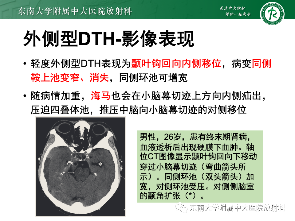 影像PPT - 【PPT】颅内疝-20