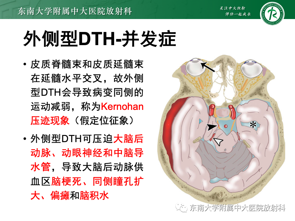 影像PPT - 【PPT】颅内疝-21