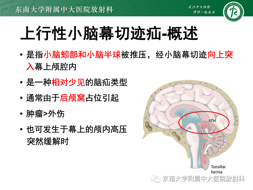 影像PPT - 【PPT】颅内疝-25