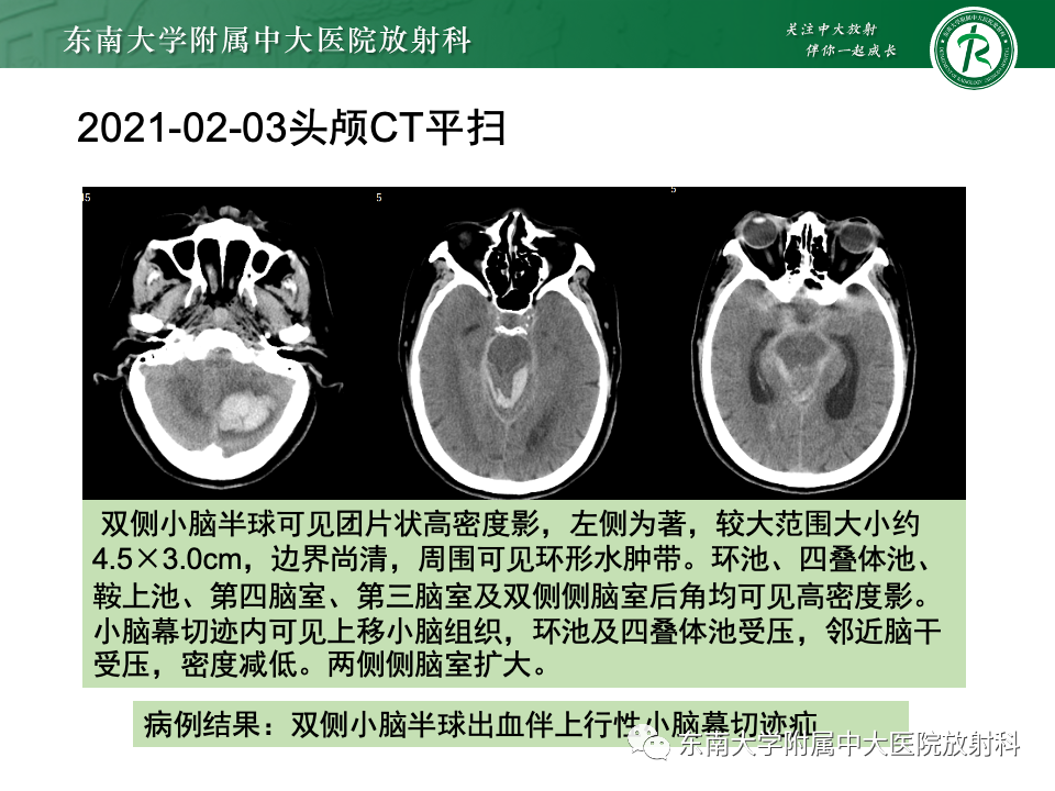 影像PPT - 【PPT】颅内疝-24