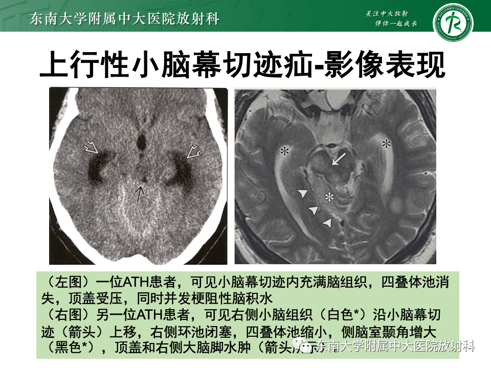 影像PPT - 【PPT】颅内疝-27