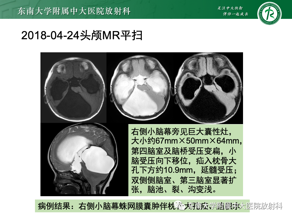 影像PPT - 【PPT】颅内疝-29