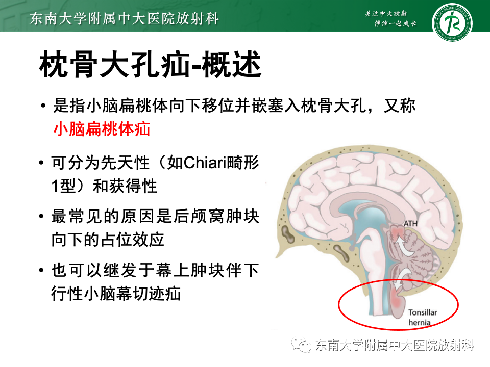 影像PPT - 【PPT】颅内疝-30