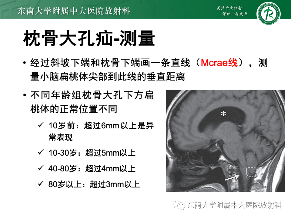 影像PPT - 【PPT】颅内疝-32