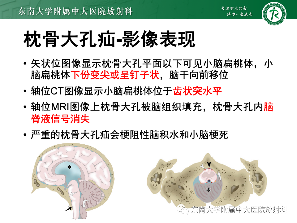 影像PPT - 【PPT】颅内疝-33