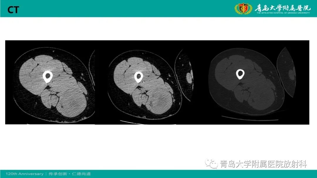 影像PPT - 【PPT】腺泡状软组织肉瘤-4