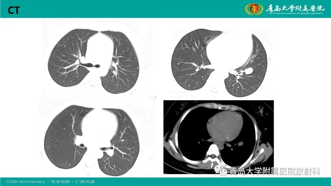 影像PPT - 【PPT】腺泡状软组织肉瘤-5