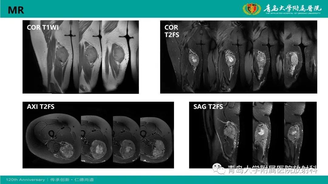 影像PPT - 【PPT】腺泡状软组织肉瘤-6