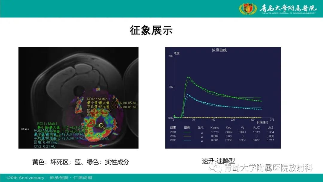 影像PPT - 【PPT】腺泡状软组织肉瘤-9