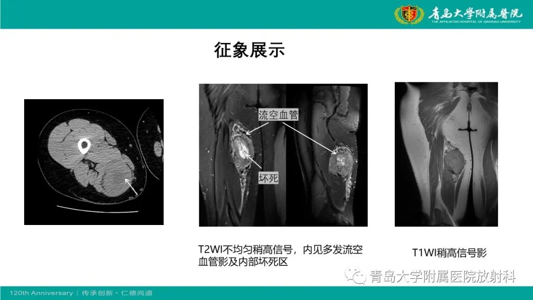影像PPT - 【PPT】腺泡状软组织肉瘤-8