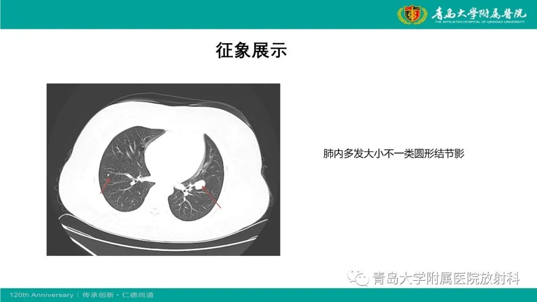 影像PPT - 【PPT】腺泡状软组织肉瘤-10