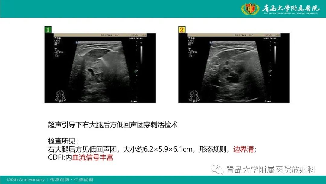影像PPT - 【PPT】腺泡状软组织肉瘤-12