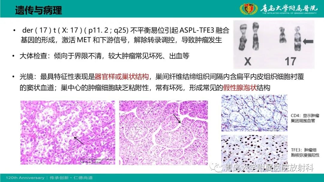 影像PPT - 【PPT】腺泡状软组织肉瘤-16