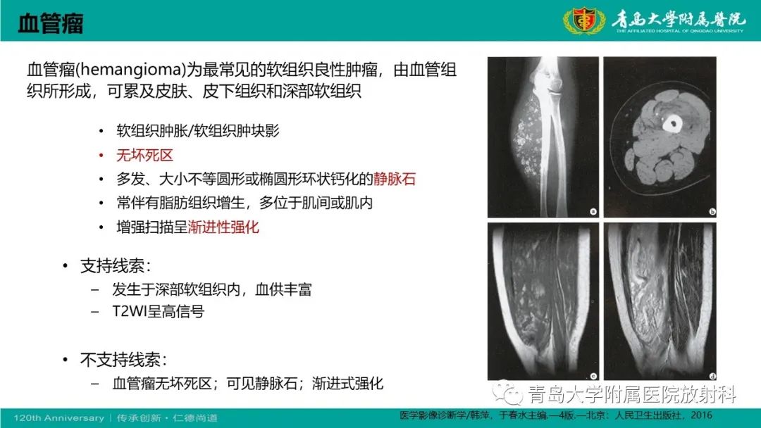 影像PPT - 【PPT】腺泡状软组织肉瘤-20