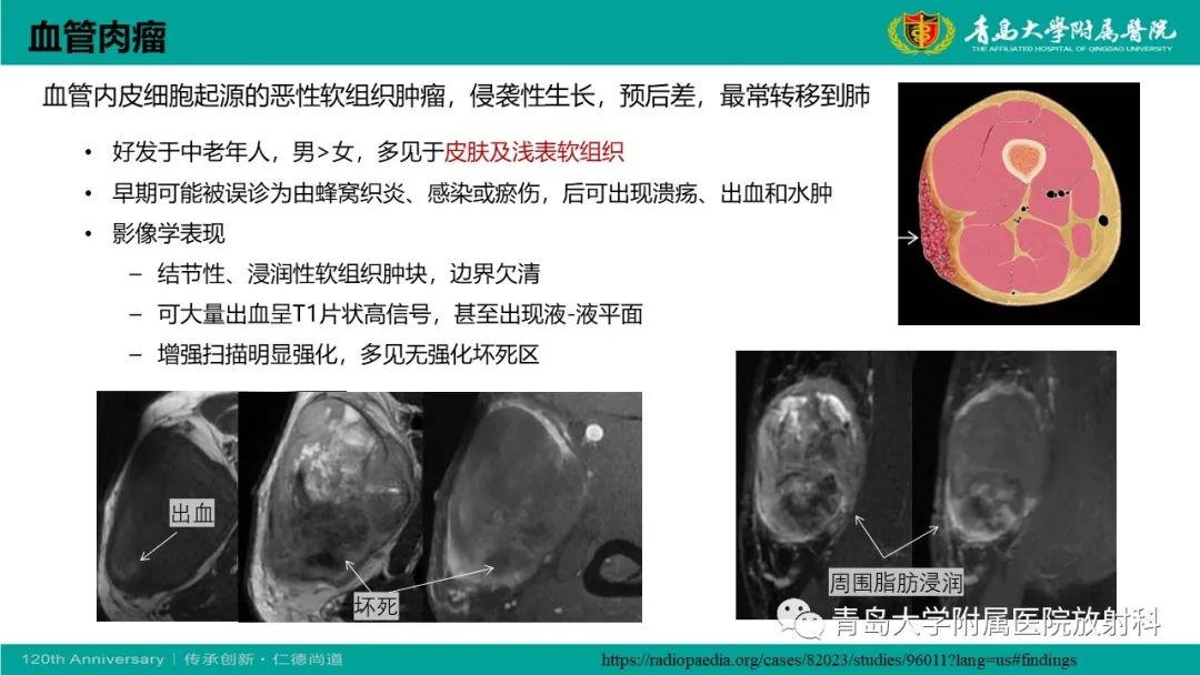 影像PPT - 【PPT】腺泡状软组织肉瘤-22