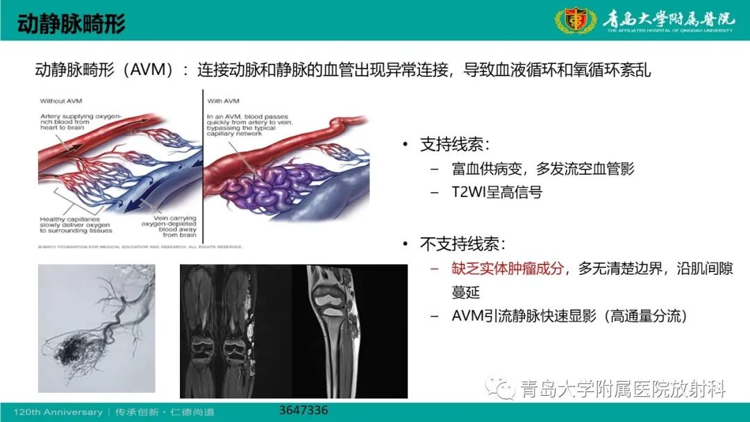 影像PPT - 【PPT】腺泡状软组织肉瘤-21