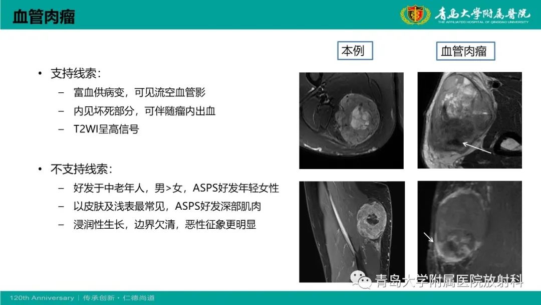 影像PPT - 【PPT】腺泡状软组织肉瘤-23