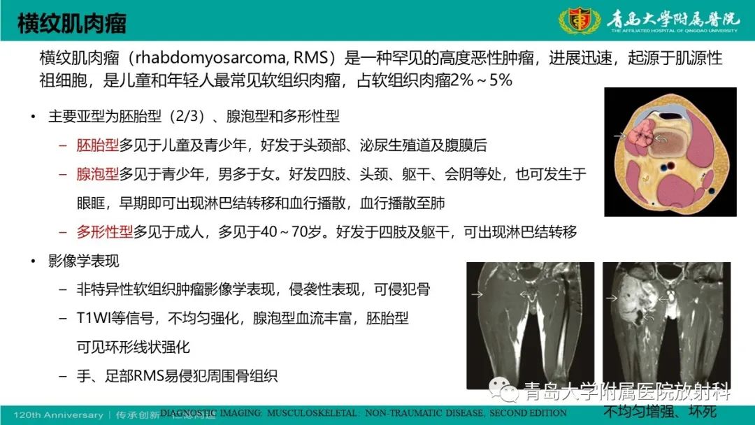 影像PPT - 【PPT】腺泡状软组织肉瘤-24