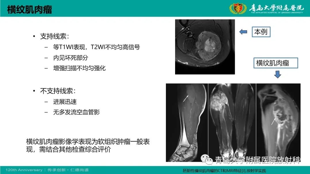 影像PPT - 【PPT】腺泡状软组织肉瘤-25