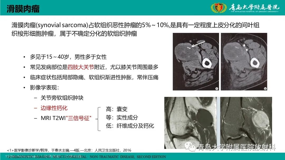 影像PPT - 【PPT】腺泡状软组织肉瘤-26