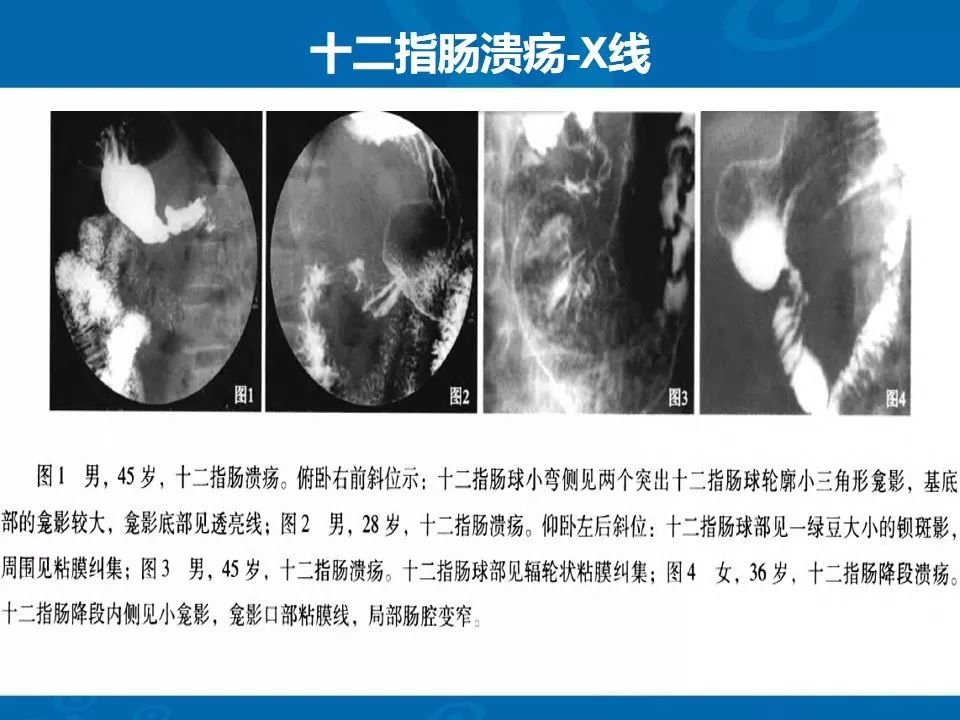 影像PPT - 【PPT】十二指肠常见病变影像诊断-4