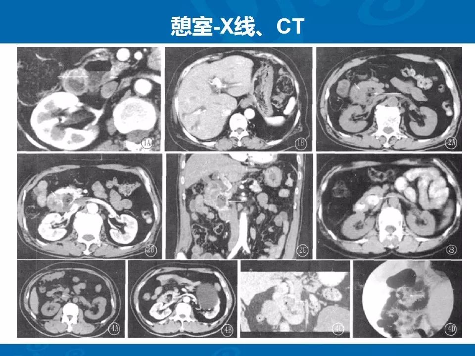 影像PPT - 【PPT】十二指肠常见病变影像诊断-7