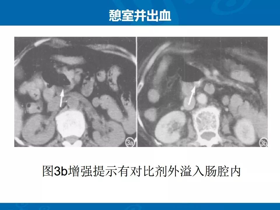 影像PPT - 【PPT】十二指肠常见病变影像诊断-8