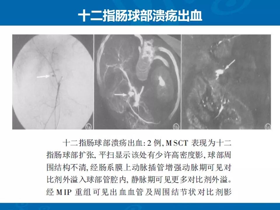 影像PPT - 【PPT】十二指肠常见病变影像诊断-10