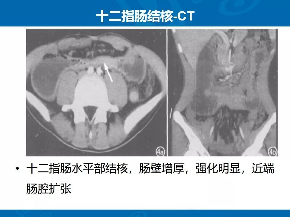 影像PPT - 【PPT】十二指肠常见病变影像诊断-9