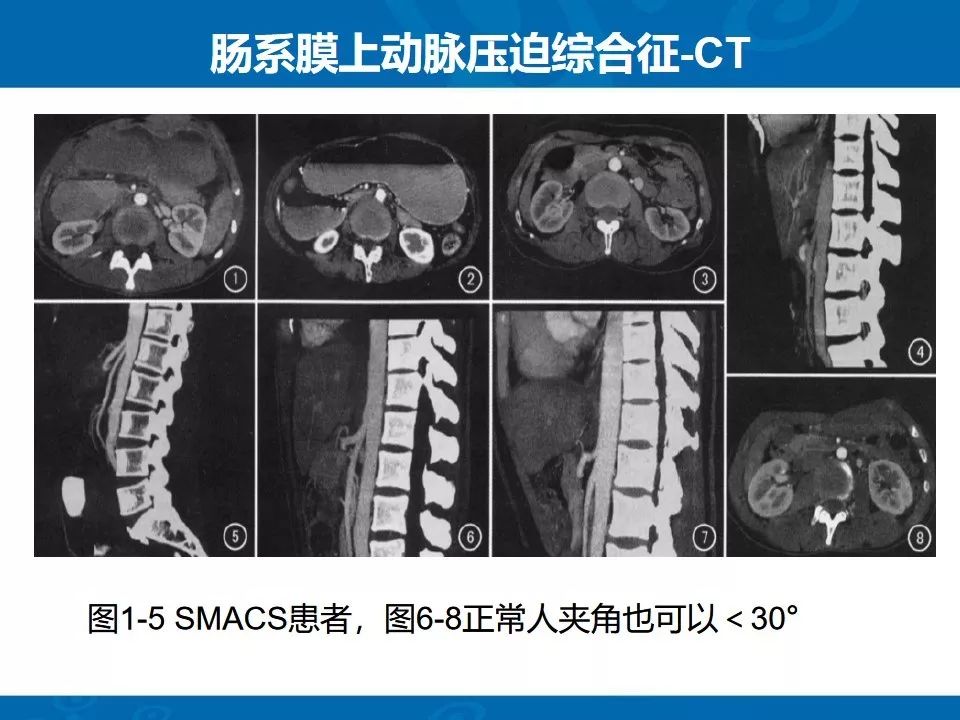 影像PPT - 【PPT】十二指肠常见病变影像诊断-15