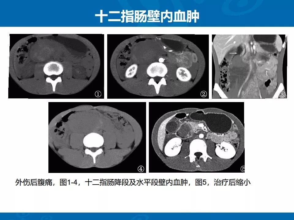 影像PPT - 【PPT】十二指肠常见病变影像诊断-17