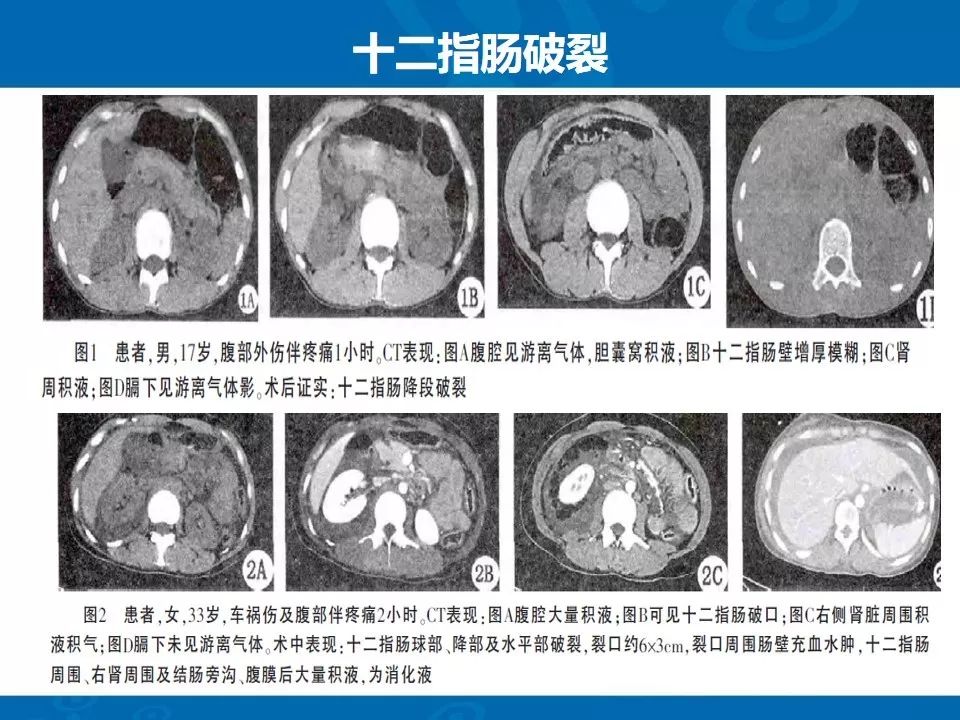 影像PPT - 【PPT】十二指肠常见病变影像诊断-19