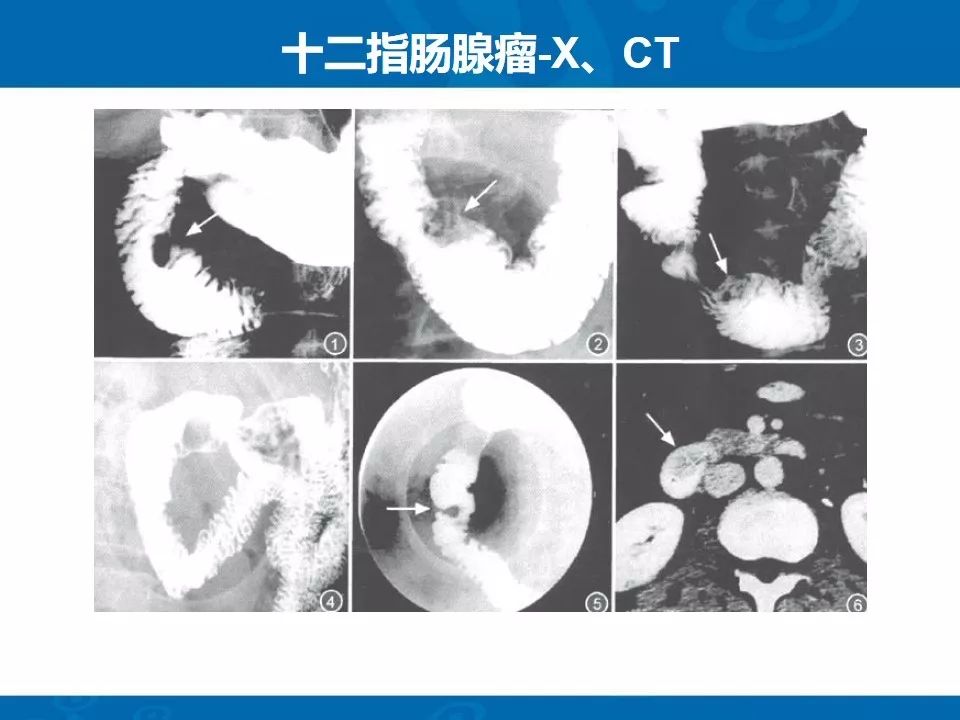 影像PPT - 【PPT】十二指肠常见病变影像诊断-22
