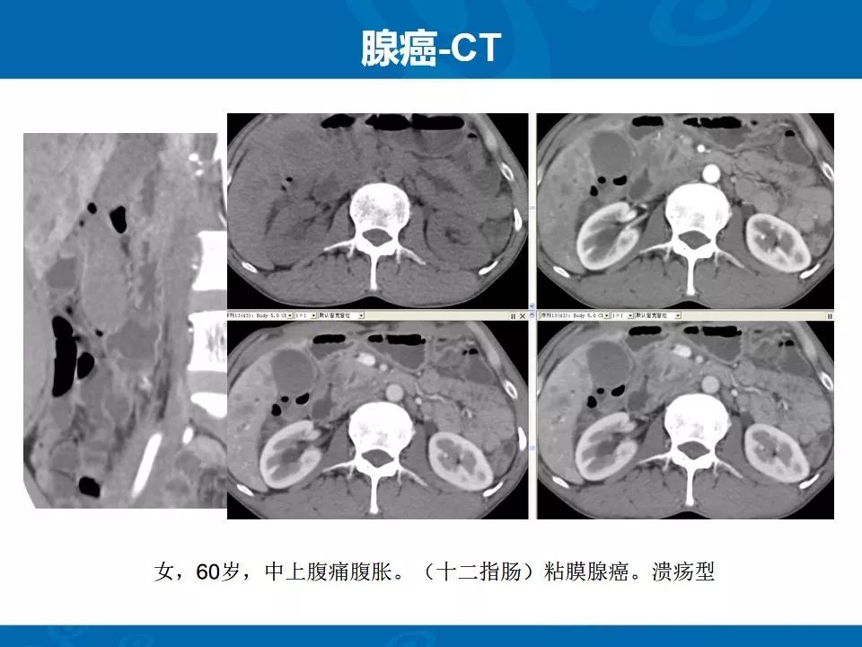 影像PPT - 【PPT】十二指肠常见病变影像诊断-26
