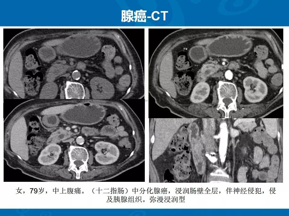 影像PPT - 【PPT】十二指肠常见病变影像诊断-27