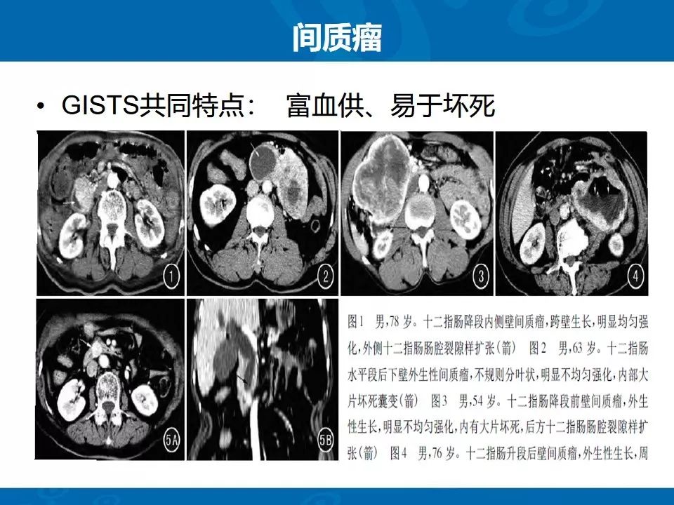影像PPT - 【PPT】十二指肠常见病变影像诊断-29