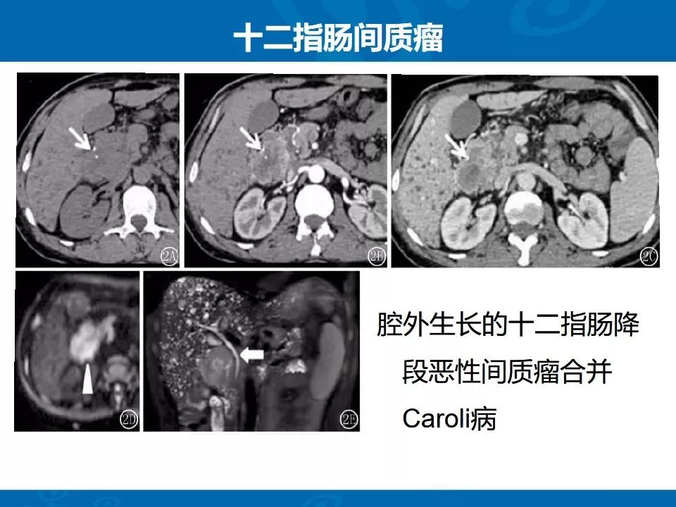 影像PPT - 【PPT】十二指肠常见病变影像诊断-30