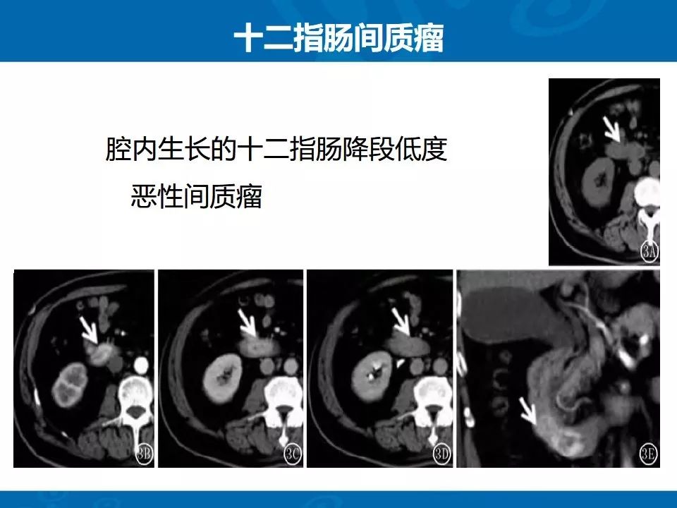 影像PPT - 【PPT】十二指肠常见病变影像诊断-31