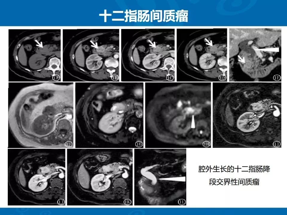 影像PPT - 【PPT】十二指肠常见病变影像诊断-32