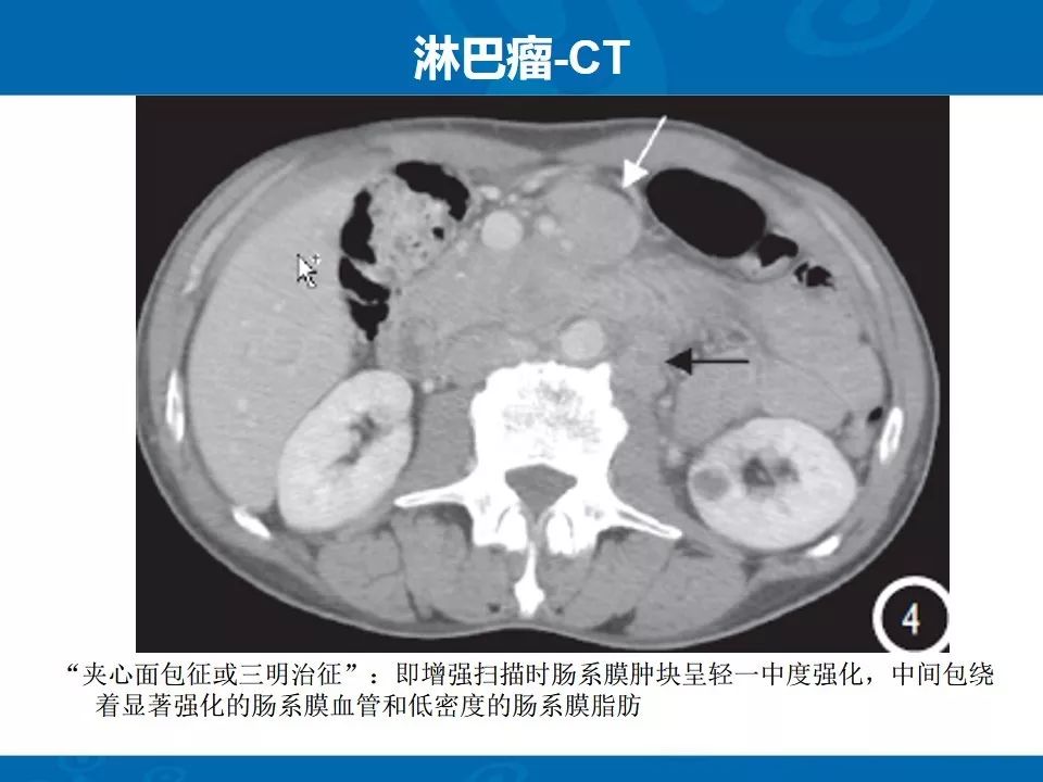 影像PPT - 【PPT】十二指肠常见病变影像诊断-35