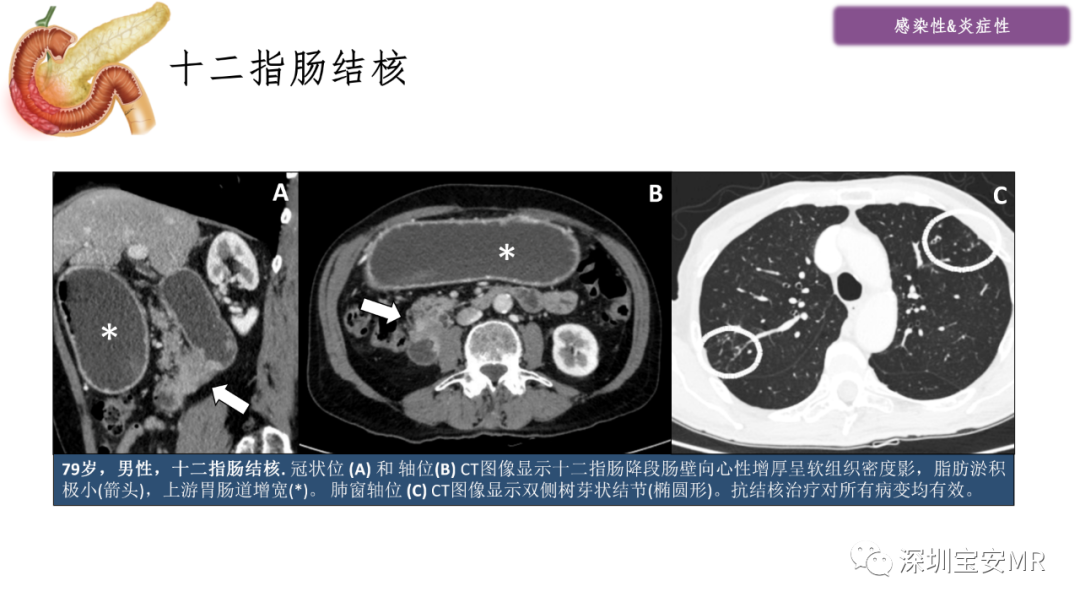 影像PPT - 【PPT】十二指肠疾病影像表现-4