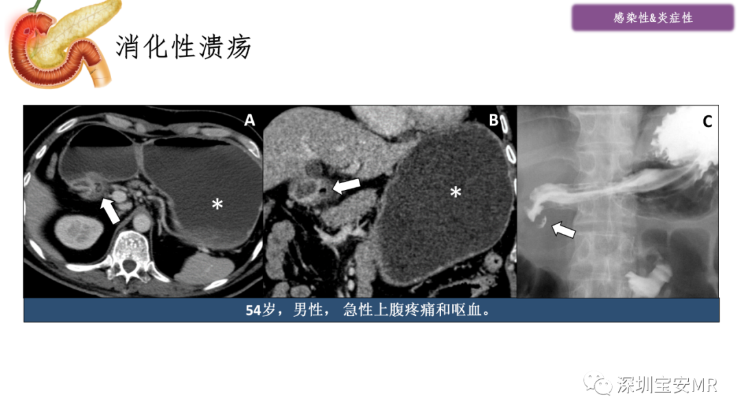 影像PPT - 【PPT】十二指肠疾病影像表现-6