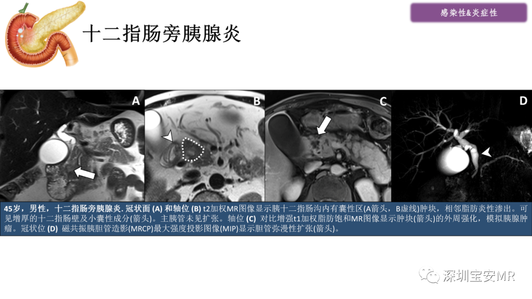 影像PPT - 【PPT】十二指肠疾病影像表现-8